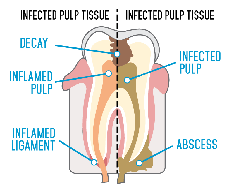 Infected Root Canal