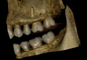 Cone beam 3d Dental xray